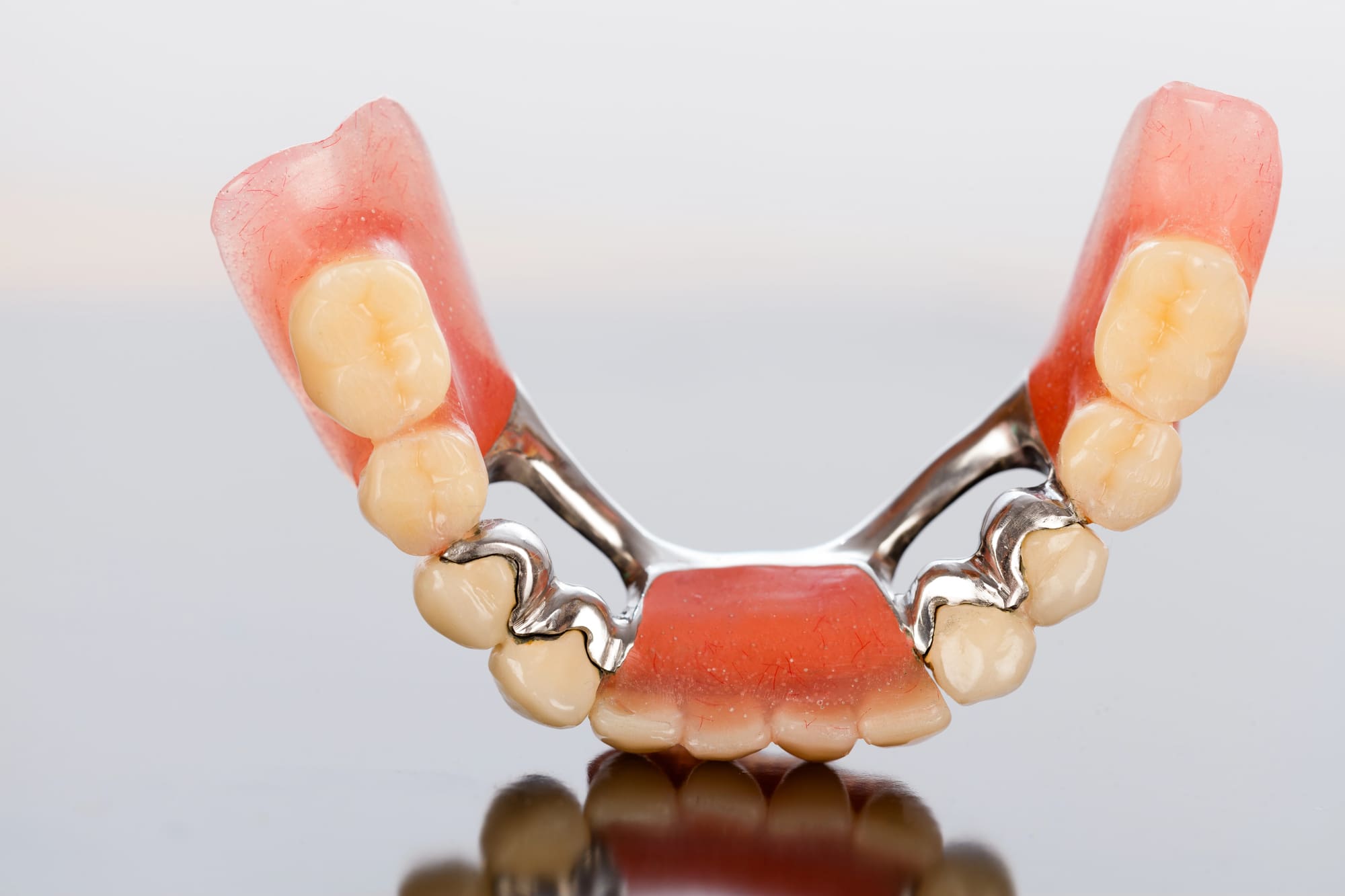 Affordable Dental Bridges Near Me: Your Guide to Cost-Effective Solutions