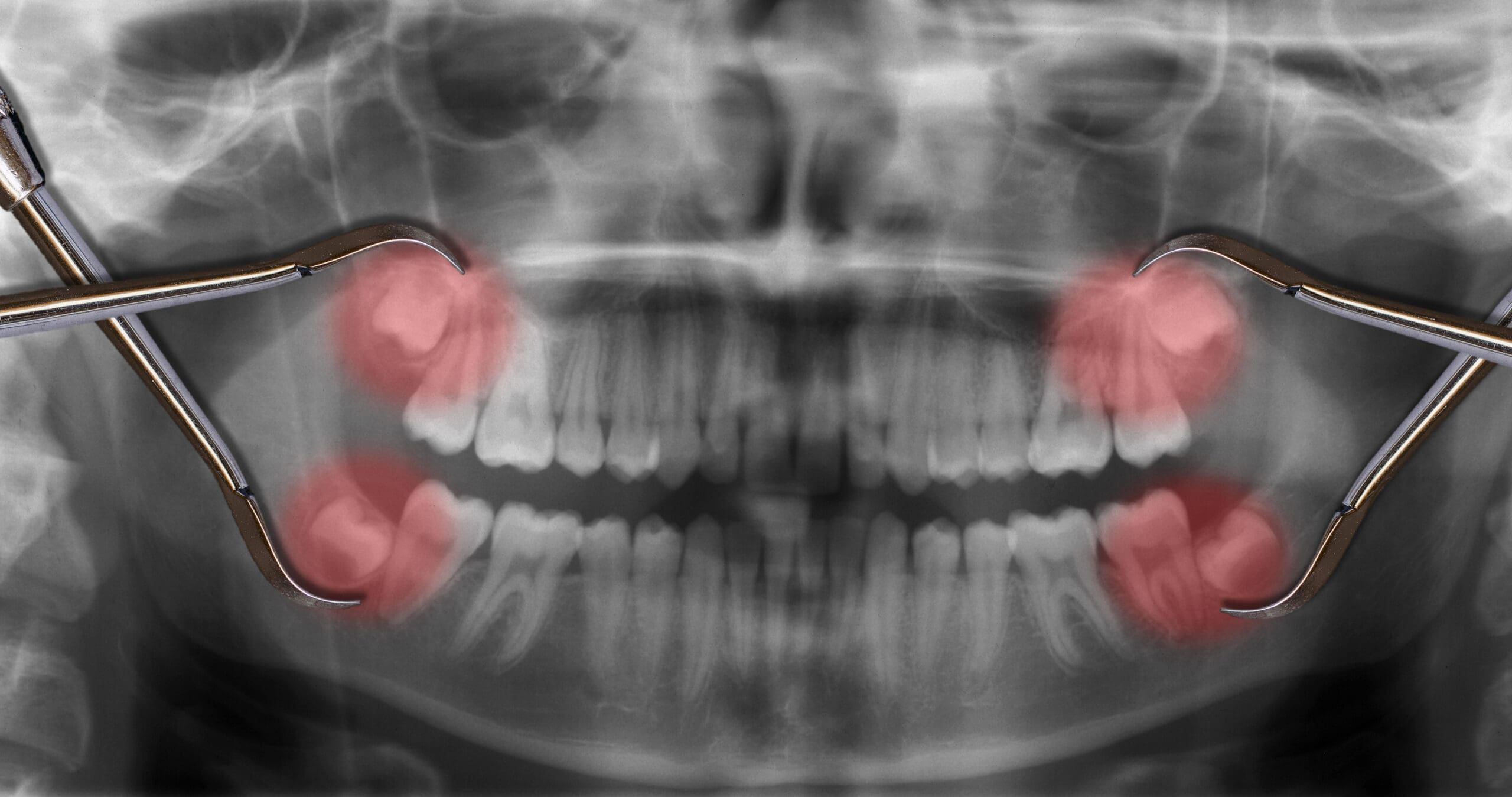 Periodontal Gum Disease for Bleeding Gums: Address the Early Signs Before It Worsens