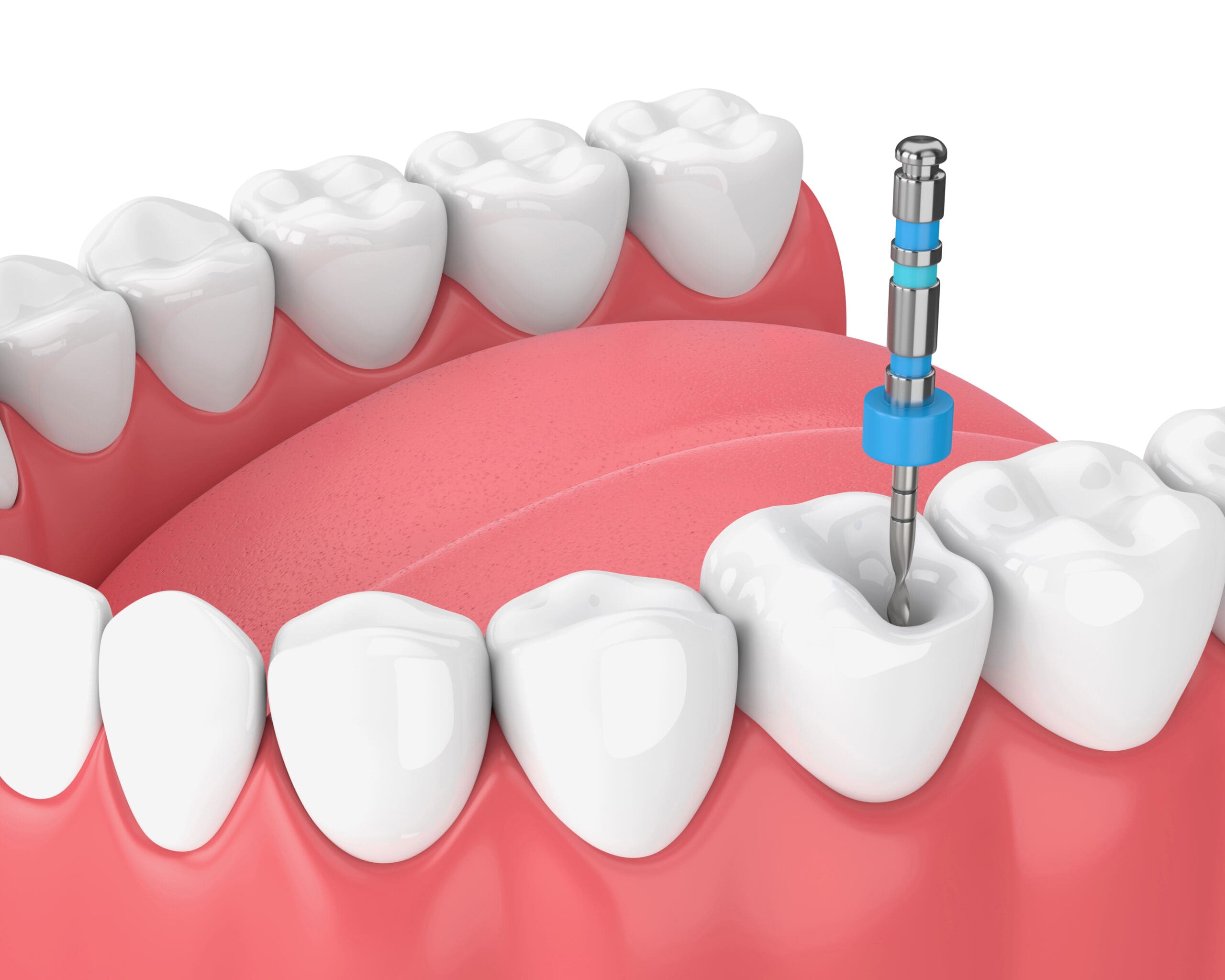 Periodontal Gum Disease Treatment Near Me: Get Professional Care Close to Home