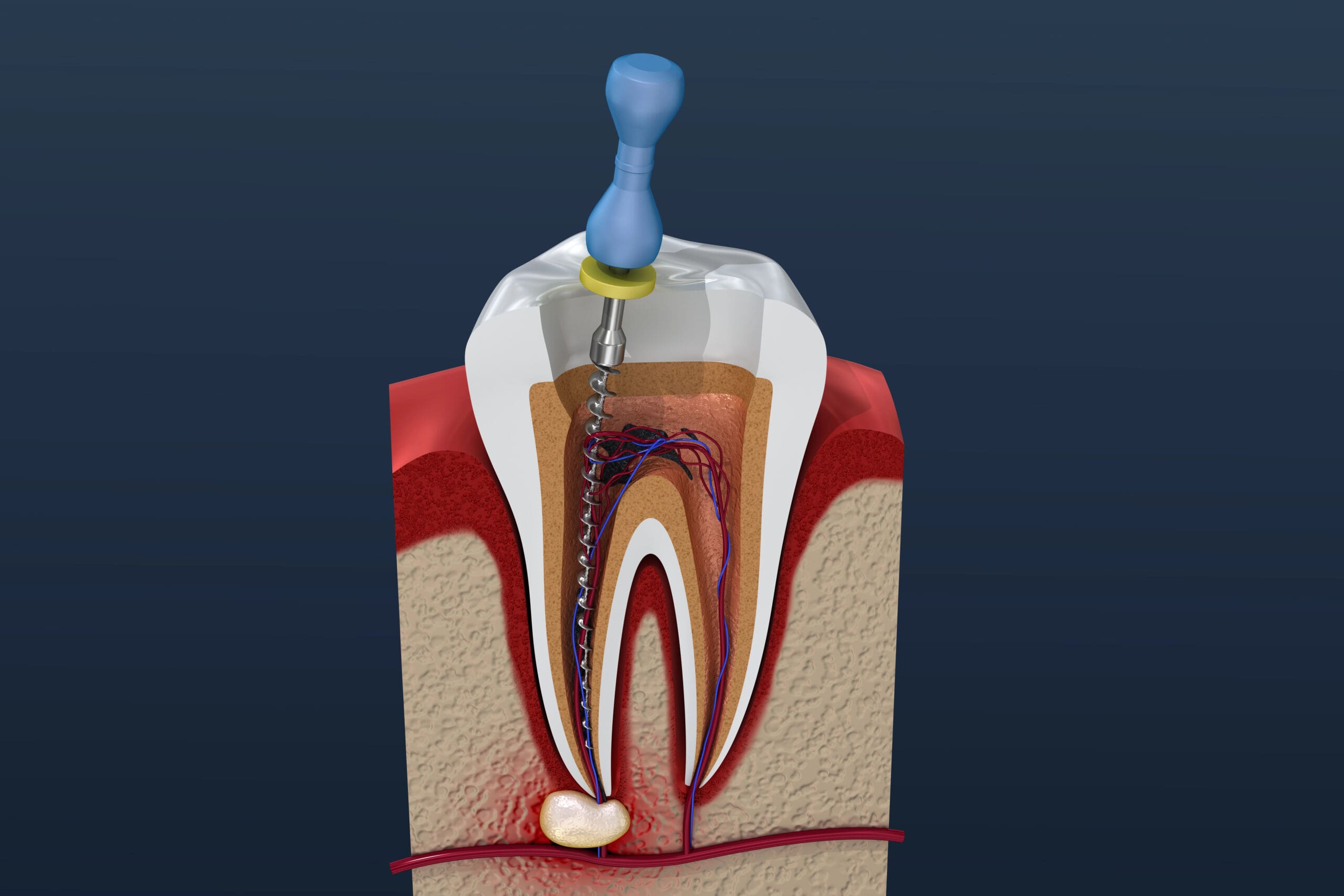 Affordable Periodontal Gum Disease Care: Protect Your Gums Without Breaking the Bank