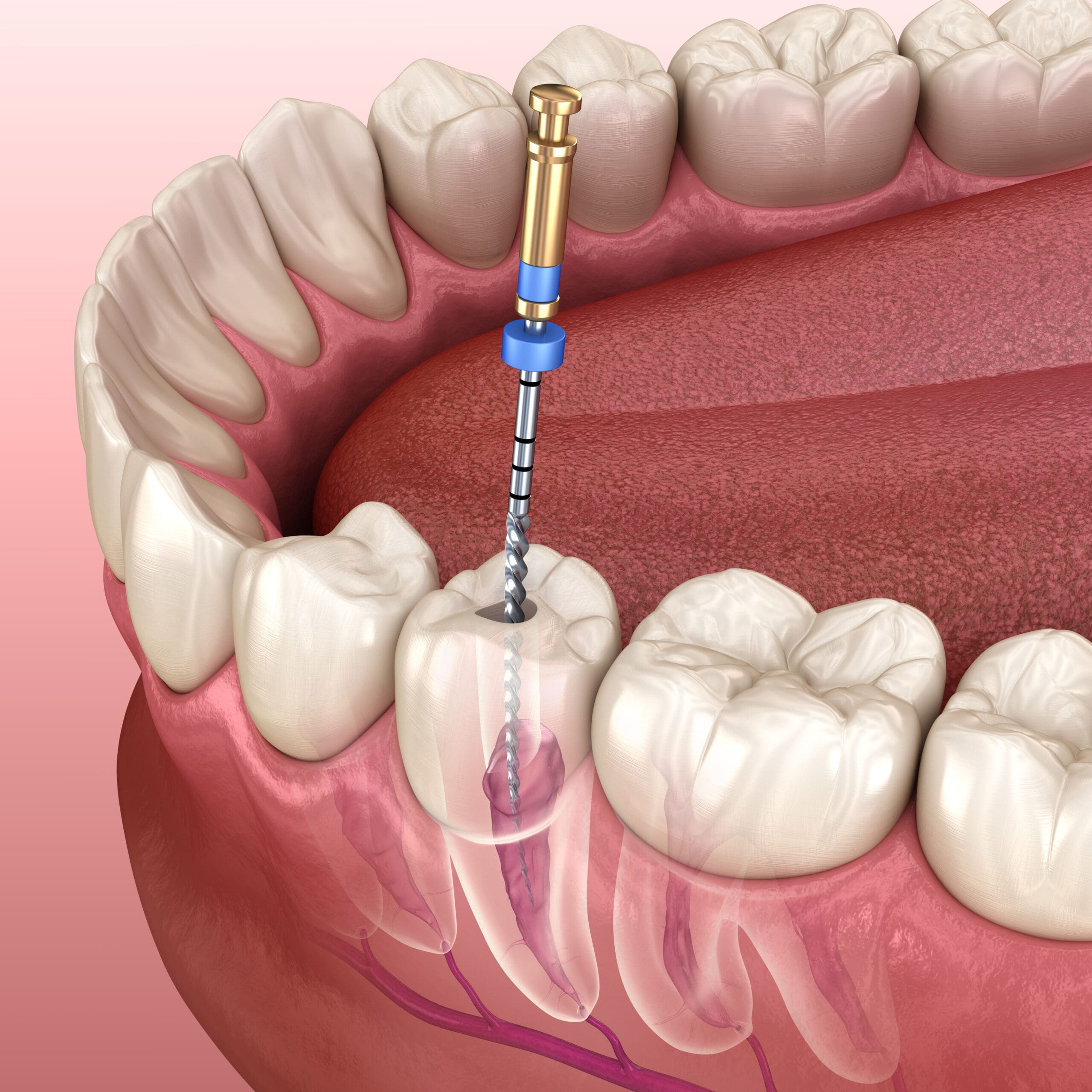 Periodontal Gum Disease vs Gingivitis: Know the Stages and Act Early