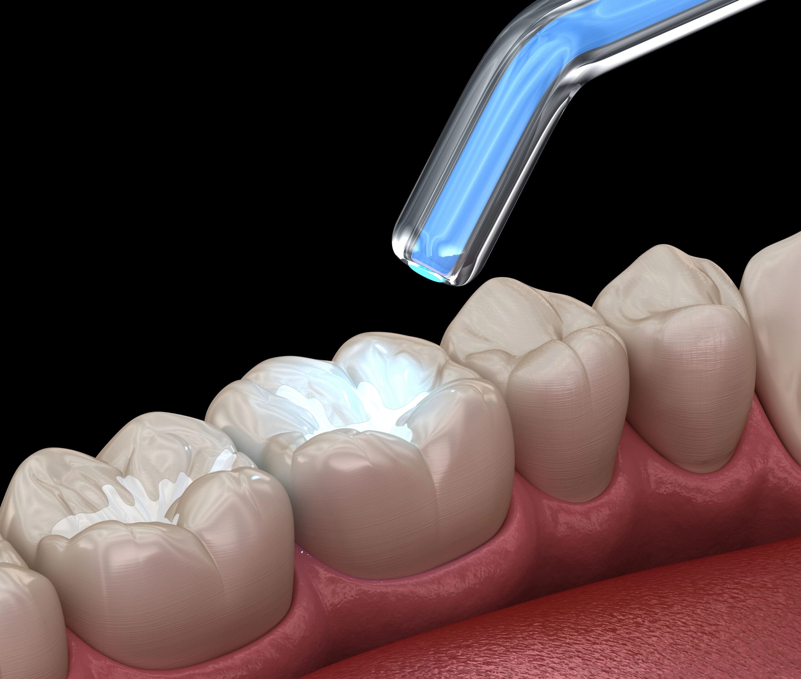 Dental Sealants for Cavity Prevention: Guard Your Smile from Decay