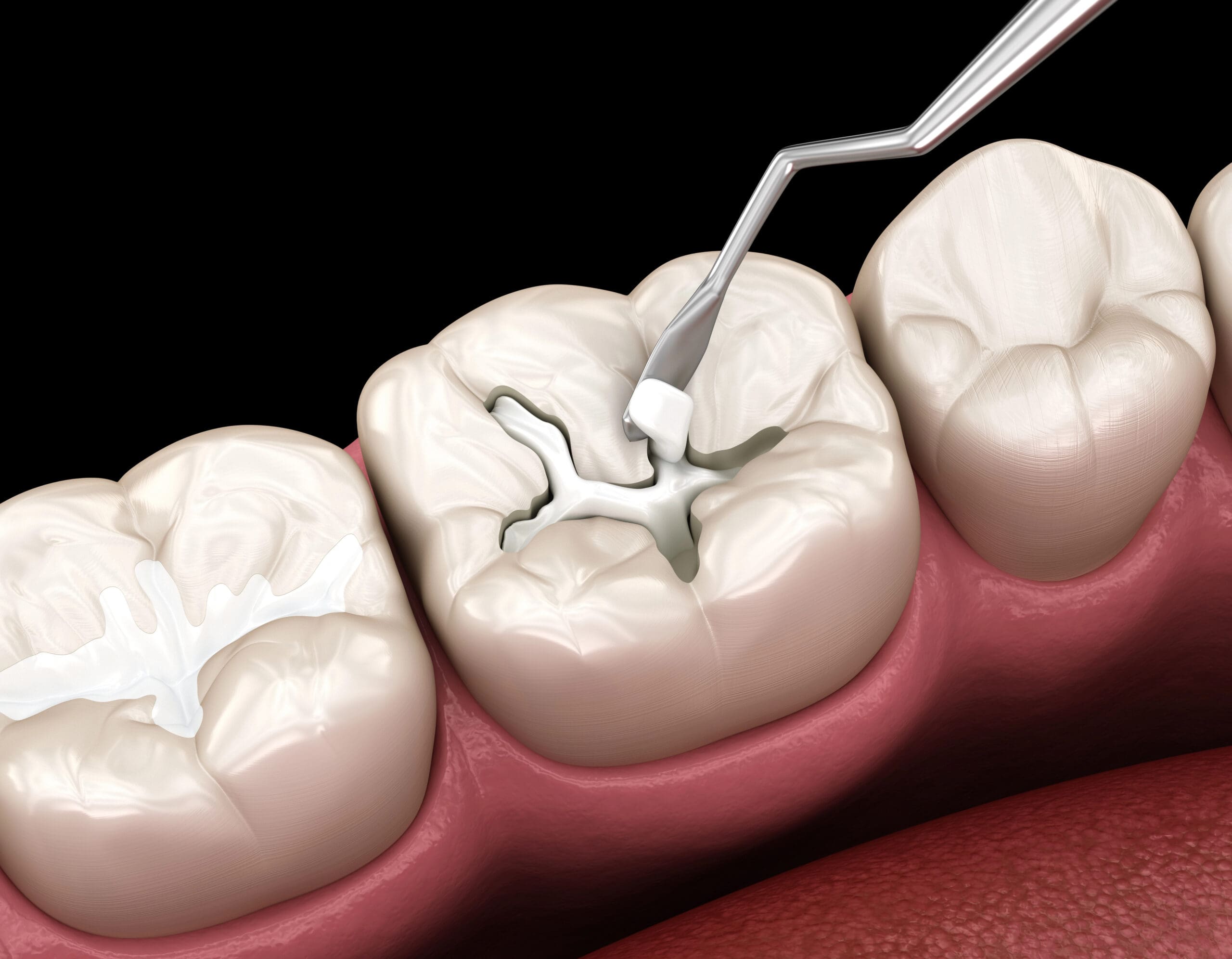 Dental Sealants vs Fillings: Know the Difference in Protective Care