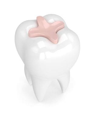 Affordable Dental Sealants: Prevent Cavities Without High Costs