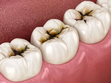 Dental Sealants Near Me: Protective Shield for Hard-to-Reach Molars